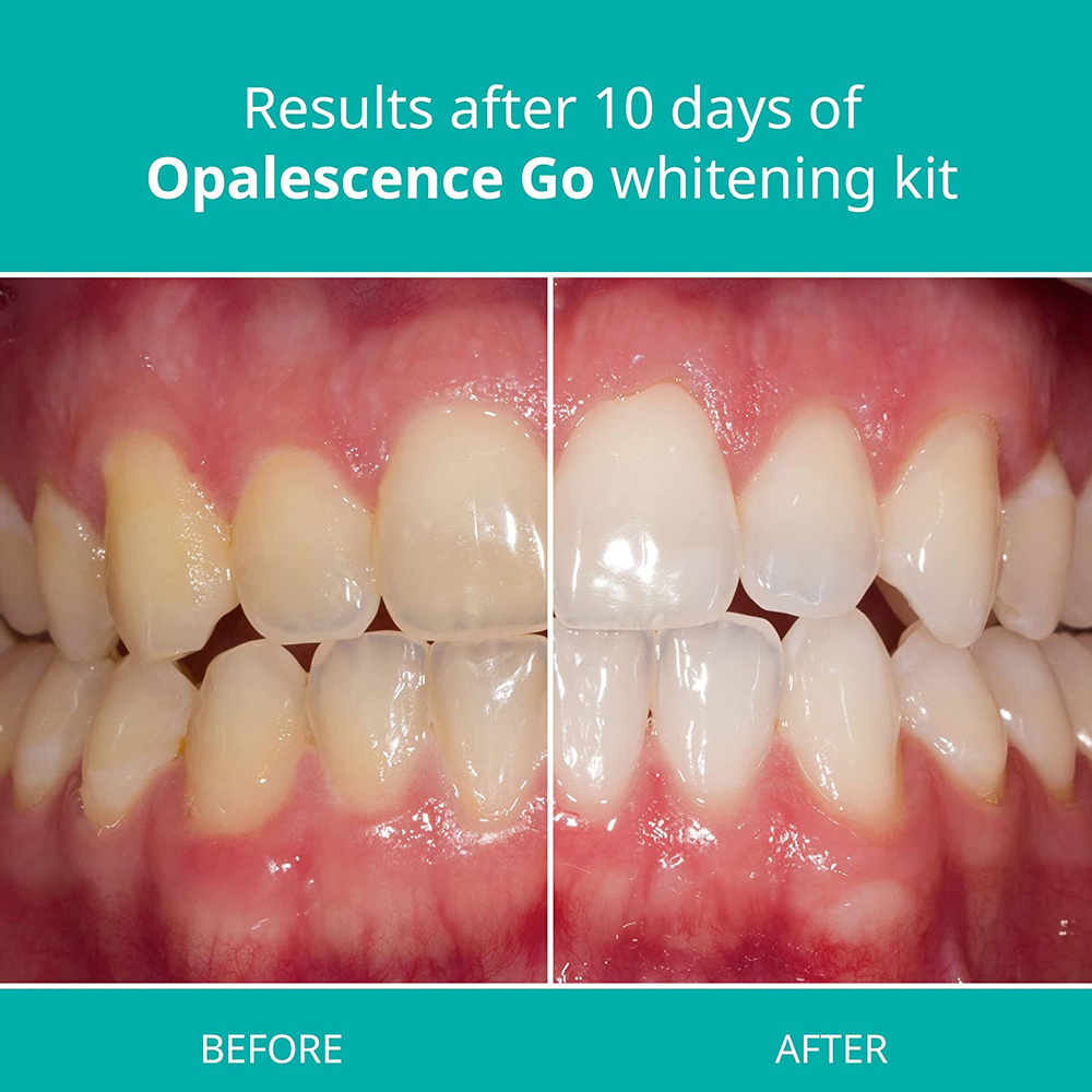 Opalescence Go Teeth Whitening - Teeth Whitening Home Kit ulasan dan harga